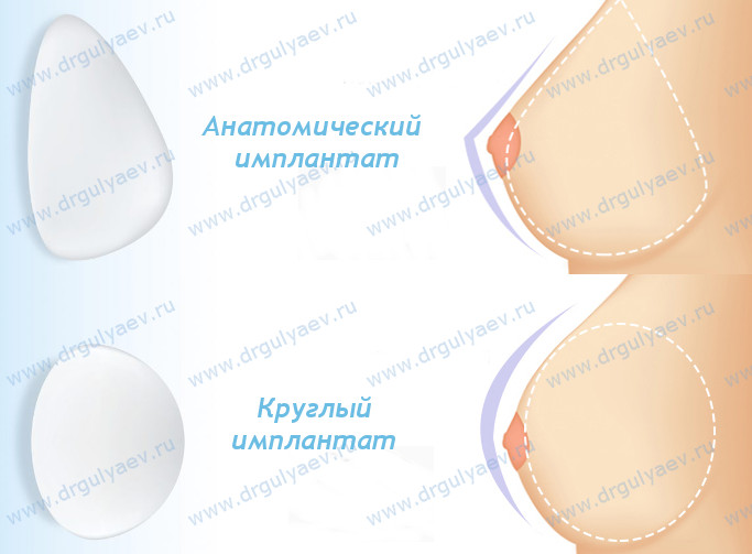 Сравнение анатомических и круглых имплантатов молочных желез